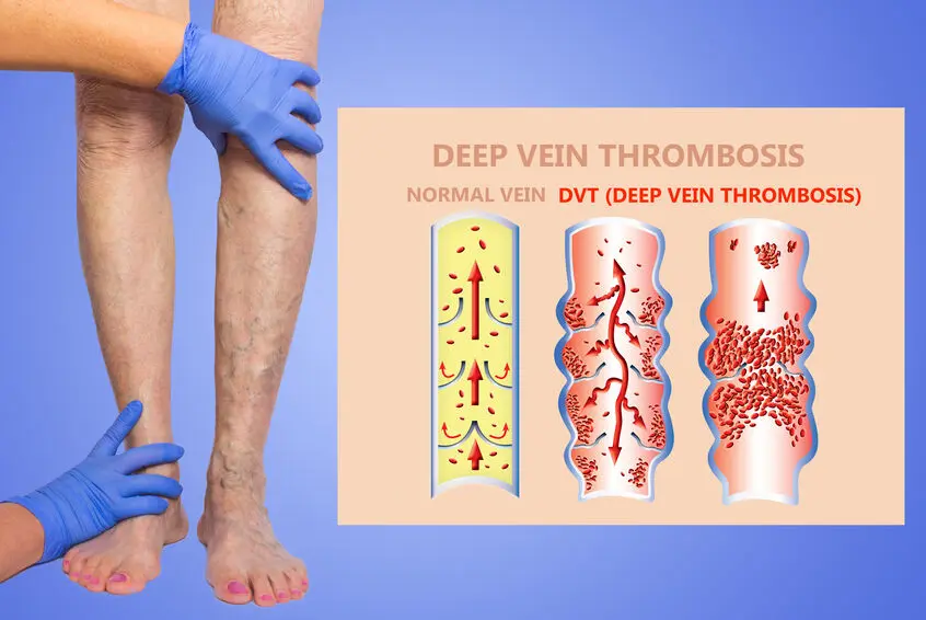 custom compression socks for dvt