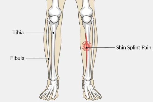 An illustration of shin splints showing pain along the shinbone and surrounding muscle areas