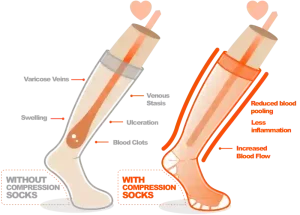 function of compression socks