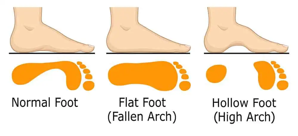 Symptom of flat foot: entire sole makes contact with the ground.