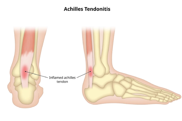 Front and side views of Achilles tendonitis, showing the inflamed tendon.