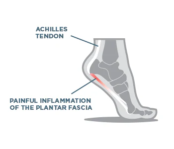 what is plantar fasciitis sock