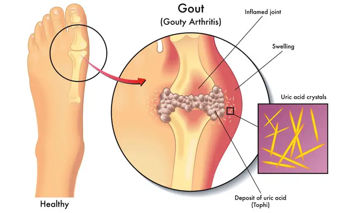 gout attack