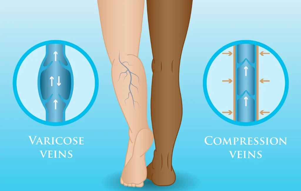 Diagram showing how graduated compression socks improve blood flow and circulation for gout relief