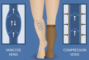compression socks for swelling 3.