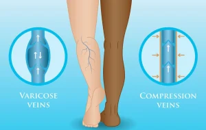 compression socks for swelling.