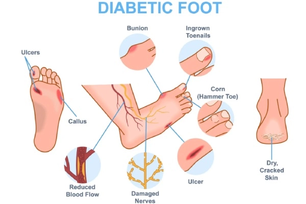 Diabetics and foot health