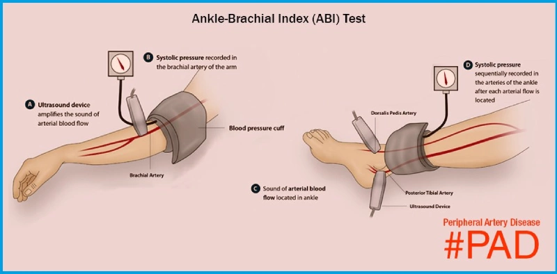 picture showing compression sock pressure levels and ankle–brachial index (ABI) evaluation for safe selection