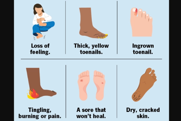 Diabetic foot assessment showing signs of poor circulation and pad, explaining who should avoid compression therapy