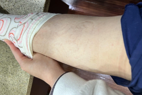 Applicable people and contraindications for compression socks: checking skin marks after use