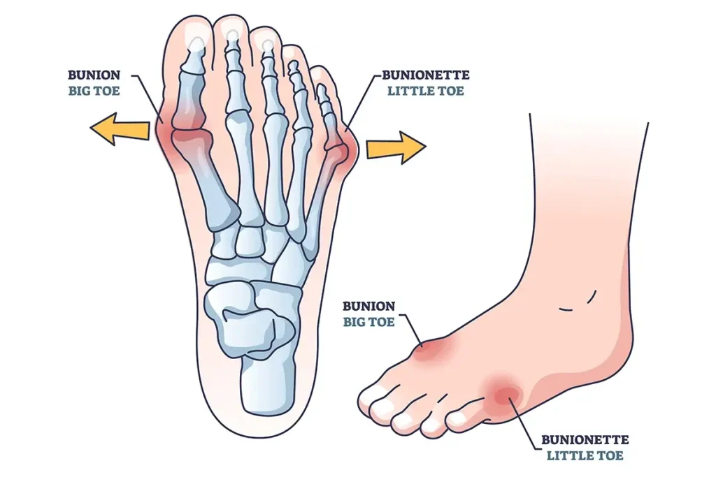 Bunion