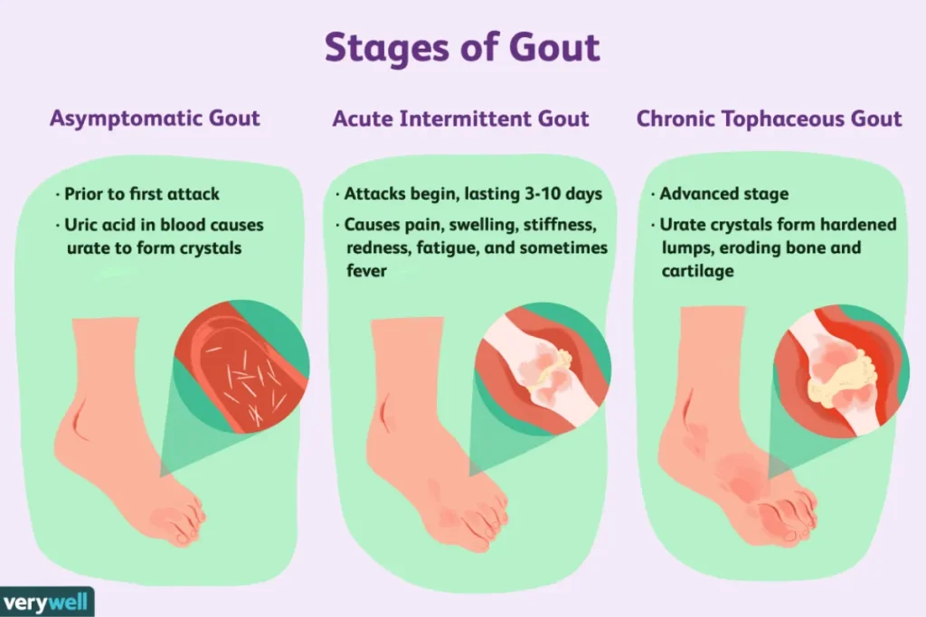 Gout