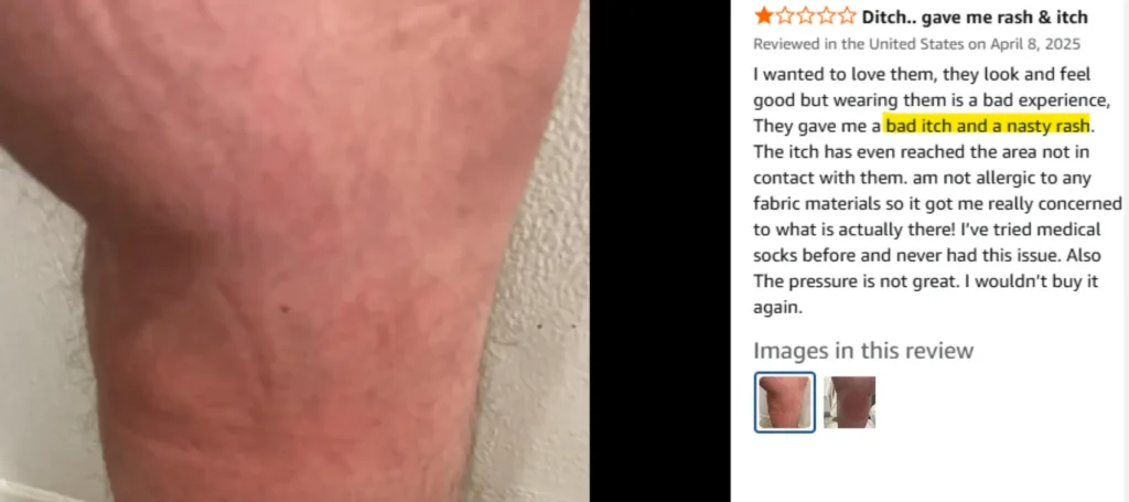 Compression socks allergy reaction example – skin rash and itchiness