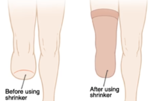 Medical grade shrinker socks with tight elastic fabric usage