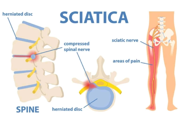 Sciatica therapy