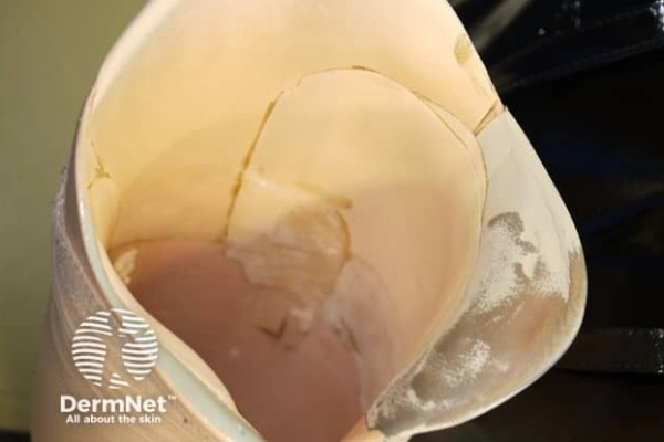 Sweating inside a prosthetic socket, showing moisture buildup.