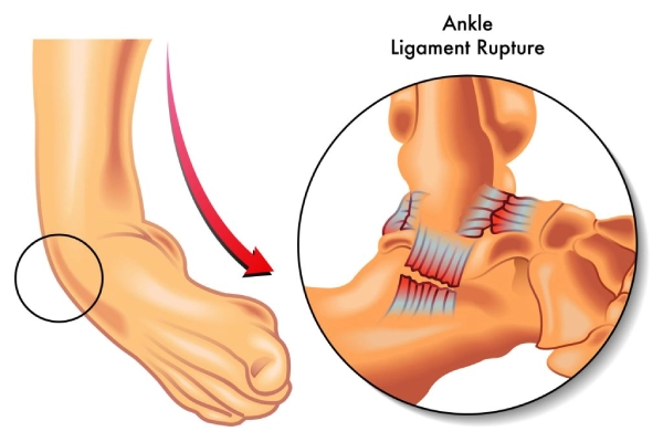 Diagram showing what is sprained ankle, highlighting ligaments and bones